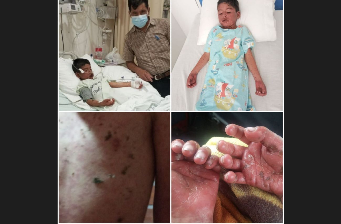 ファイザー製コロナワクチンを2回接種した8歳の男の子、全身の皮膚や粘膜が壊死する「スティーブンス・ジョンソン症候群」を発症