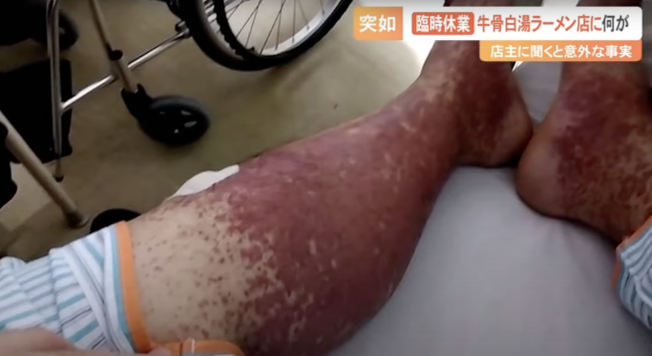 鳥取県の人気ラーメン店が突然の臨時休業　店主の足が腫れあがり、全身に激痛　コロナワクチン接種後に増加した『IgA血管炎』の恐怖