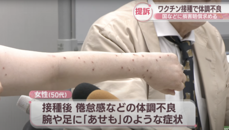 【薬害】岡山県に住む50代女性、コロナワクチン接種後に体調不良になったとして国や製薬会社に約1320万円の損害賠償を求める　皮膚からワクチン由来の『スパイクタンパク質』が長期で検出