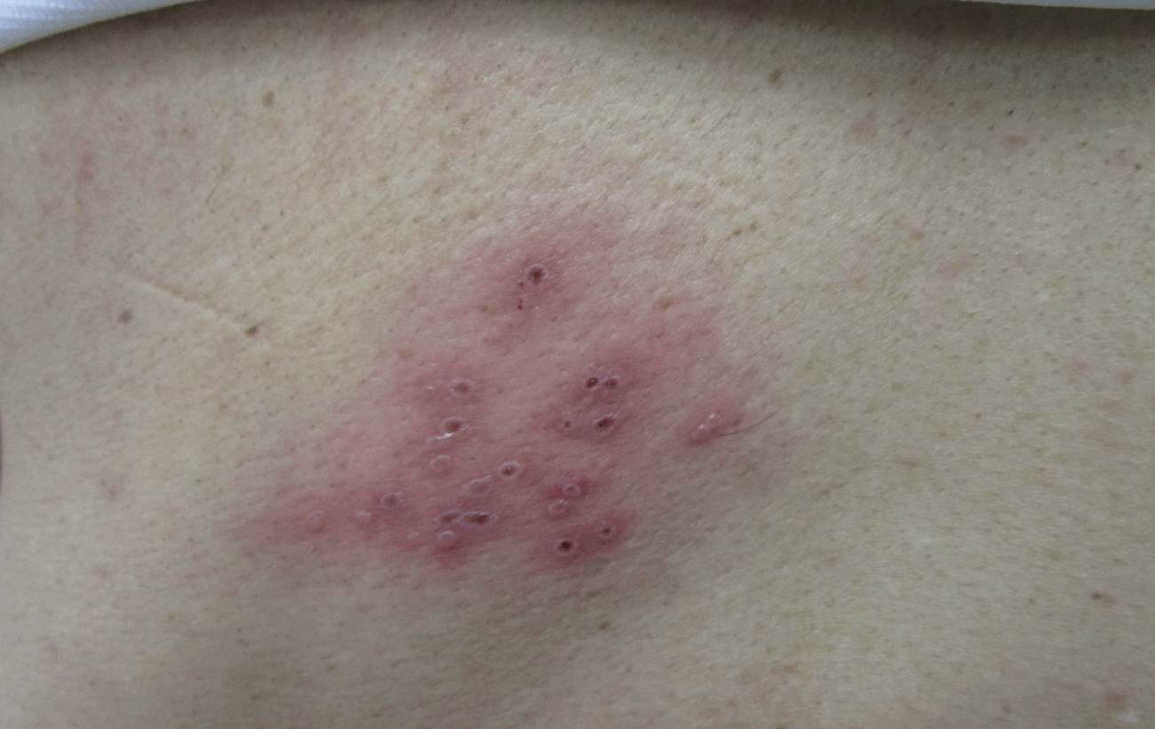 【韓国】帯状疱疹の患者数が年々増加、2024年までの過去6年間で計356万人に ワクチン接種費用の支援を求める声が高まる